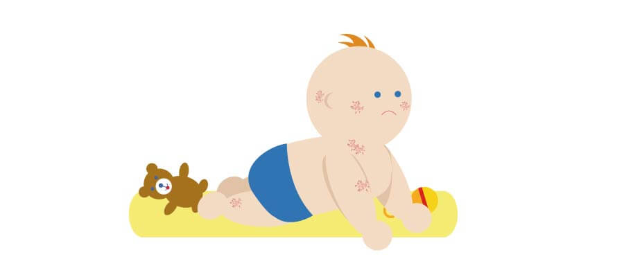 Illustration of baby with eczema